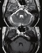 Image result for Ataxia MRI