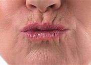 Image result for Upper Lip Wrinkles