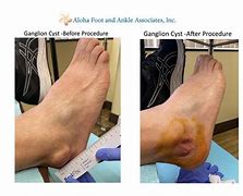 Image result for Ganglion Cyst in Capitate