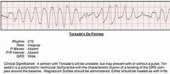 Image result for Polymorphic Wide Complex Tachycardia