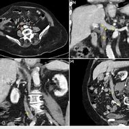 Image result for IVC Thrombs Post-Mortem