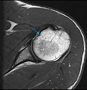 Image result for Shoulder MRI