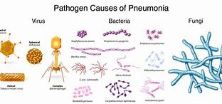 Image result for Pathogens Causing Pneumonia