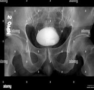 Image result for Normal Bladder