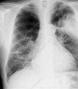 Image result for Bullous Emphysema X-ray