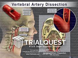 Image result for Vertebral Dissection On Angiogram