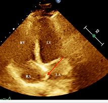 Image result for Septal Aneurysm