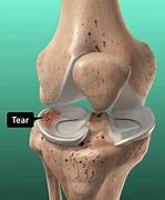 Image result for Right Knee Meniscus