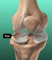 Image result for Knee Joint Meniscus