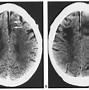 Image result for CT Brain Lentiform Nucleus