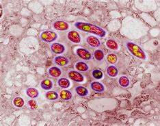 Image result for Mycobacterium Avium Infection