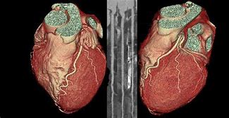 Image result for Coronary CT Angiography CTA