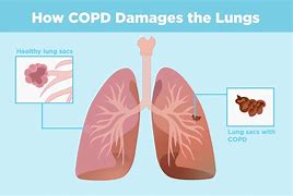 Image result for COPD Pinterest