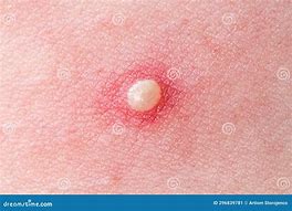 Image result for Infected Acne Pustules