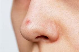 Image result for Pustules On Nose