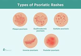 Image result for Psoriatic Pustules