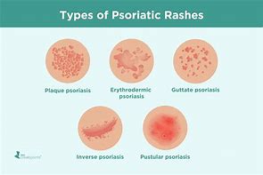 Image result for Pustule Rashes