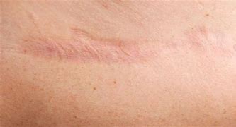 Image result for Atrophic Scar Treatment