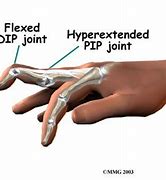 Image result for Dislocated PIP Joint in Pinky Finger