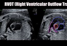 Image result for Rvot and LVOT Fetal Ultrasound Images Colour