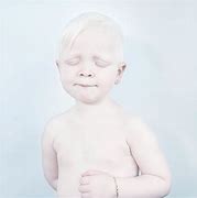 Image result for Albino Boy