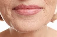 Image result for How to Remove Wrinkles around Mouth