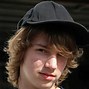 Image result for Acne Boy Face Map