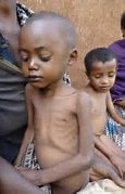 Image result for Starving Ethiopian Child