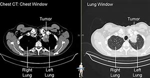 Image result for Lung Cancer On CT