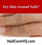 Image result for Hard Skin Remover On Hands Clicks