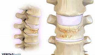 Image result for Osteoporosis Lumbar Spine