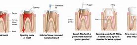 Image result for Root Canal Darkening