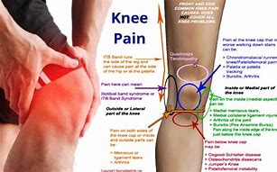 Image result for Capitate Bone Pain