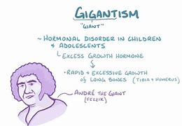 Image result for Example of Gigantism