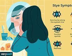 Image result for Stye Symptoms