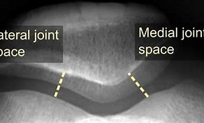 Image result for Patellofemoral Joint Space Narrowing