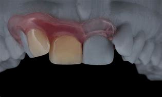 Image result for Valplast Partial One Tooth