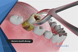 Image result for Alendronate and Tooth Extraction