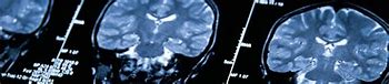 Image result for Childhood Brain Cancer