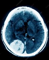 Image result for Small Calcified Meningioma CT Image