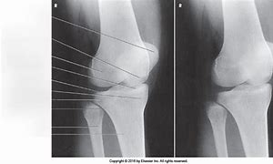 Image result for PA Oblique Lateral Rotation Knee