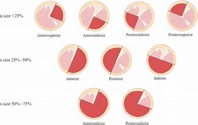 Image result for Tympanic Perforation