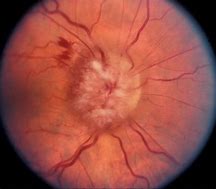 Image result for Papilledema