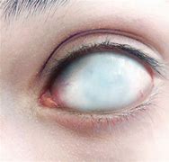 Image result for Full White Eyes Male