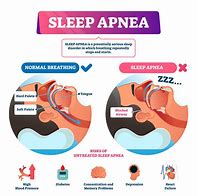 Image result for hypertension sleep apnea cpap