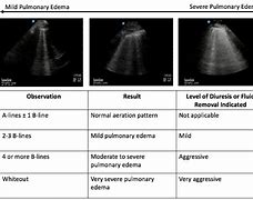 Image result for Lung Ultrasound B Lines Pulmonary Edema