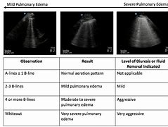 Image result for Pulmonary Regurg Ultrasound Flame