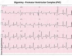 Image result for Bigeminy PVC ECG