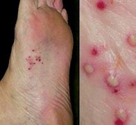 Image result for Lower Leg Pustules