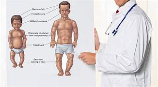 Image result for Achondroplasia Growth Chart